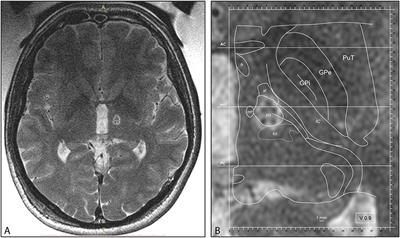 MRgFUS Pallidothalamic Tractotomy for Chronic Therapy-Resistant Parkinson's Disease in 51 Consecutive Patients: Single Center Experience